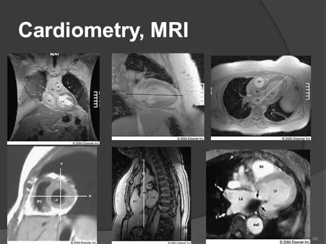 Cardiometry, MRI 69