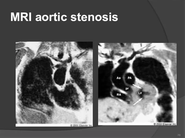 MRI aortic stenosis 70