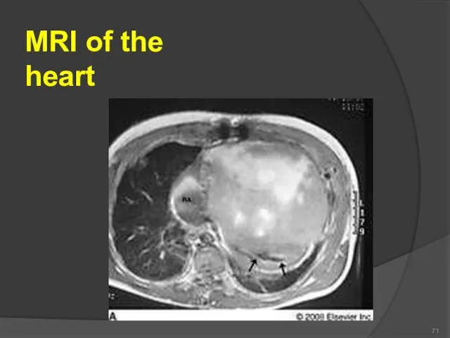 MRI of the heart 71