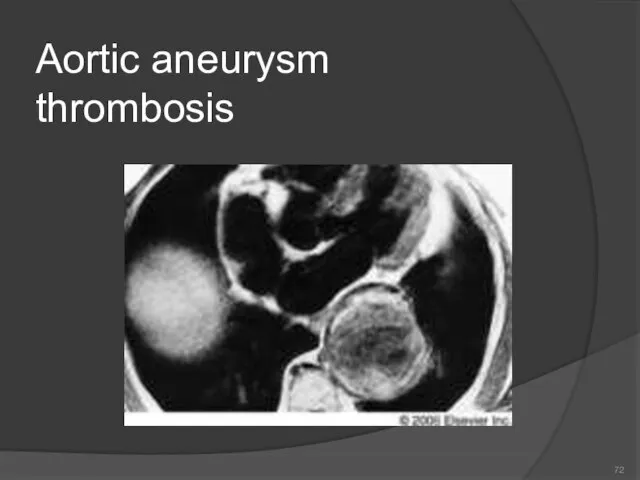 Aortic aneurysm thrombosis 72