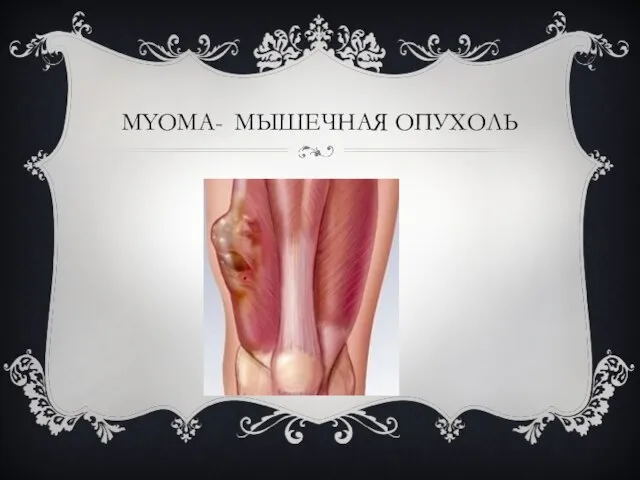 MYOMA- МЫШЕЧНАЯ ОПУХОЛЬ