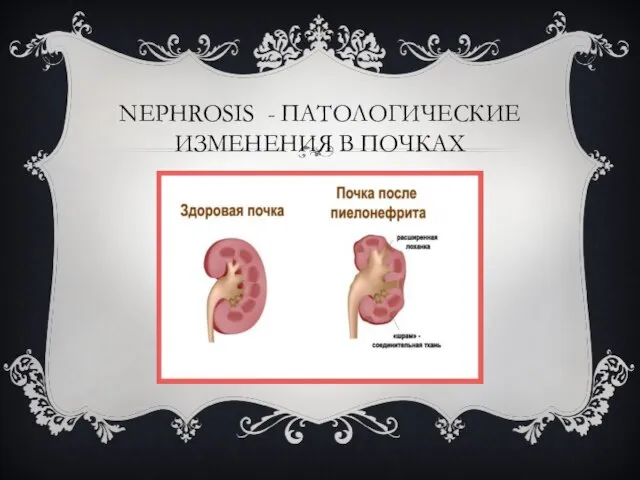 NEPHROSIS - ПАТОЛОГИЧЕСКИЕ ИЗМЕНЕНИЯ В ПОЧКАХ