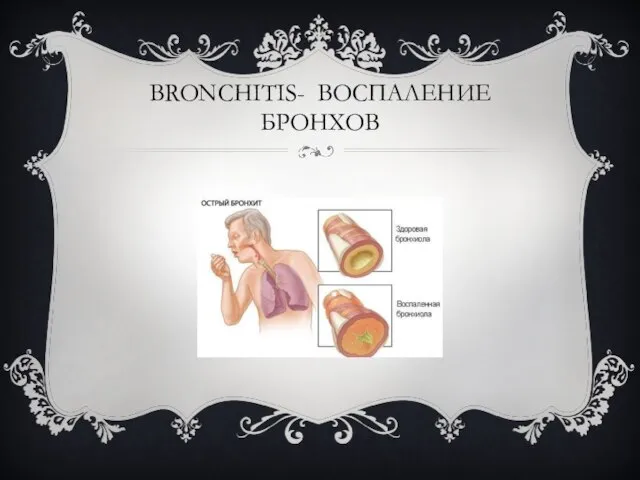 BRONCHITIS- ВОСПАЛЕНИЕ БРОНХОВ
