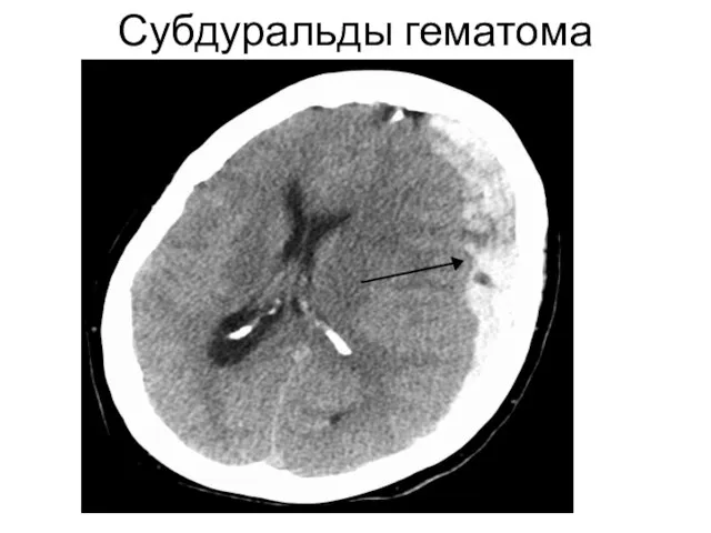 Субдуральды гематома