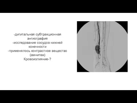 -дигитальная субтракционная ангиография -исследование сосудов нижней конечности -применялось контрастное вещество (амнипак) Кровоизлияние-?