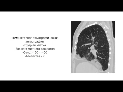 -компьютерная томографическая ангиография -Грудная клетка -без контрастного вещества -Окно: -150 - -400 -Ателектаз - ?