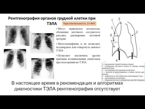 Чувствительность 23-49% В настоящее время в рекомендацих и алгоритмах диагностики ТЭЛА рентгенография отсутствует