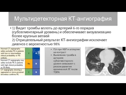 Мультидетекторная КТ-ангиография 1) Видит тромбы вплоть до артерий 6-го порядка (субсегментарный уровень)