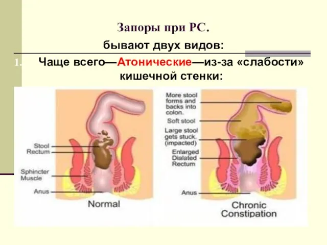 Запоры при РС. бывают двух видов: Чаще всего—Атонические—из-за «слабости» кишечной стенки: