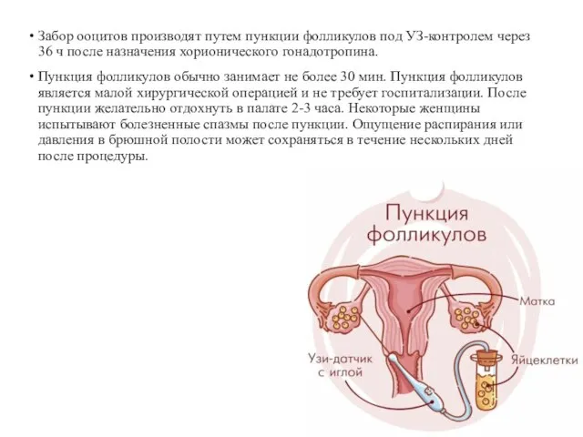 Забор ооцитов производят путем пункции фолликулов под УЗ-контролем через 36 ч после