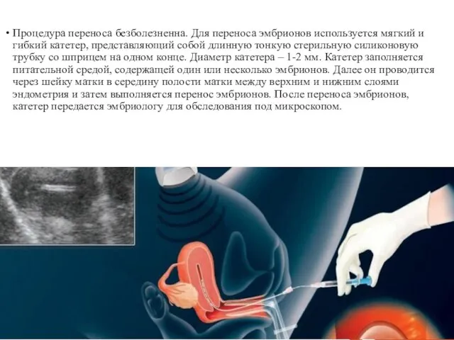 Процедура переноса безболезненна. Для переноса эмбрионов используется мягкий и гибкий катетер, представляющий