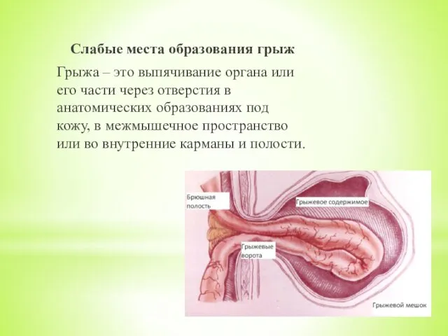 Слабые места образования грыж Грыжа – это выпячивание органа или его части