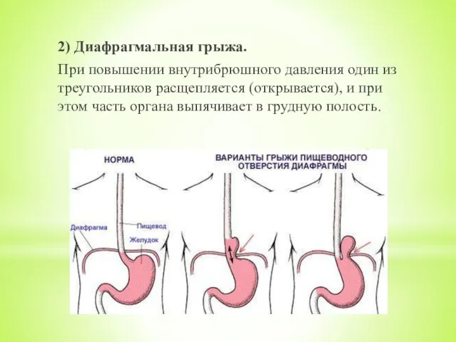 2) Диафрагмальная грыжа. При повышении внутрибрюшного давления один из треугольников расщепляется (открывается),