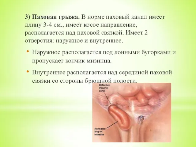 3) Паховая грыжа. В норме паховый канал имеет длину 3-4 см., имеет