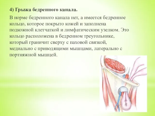 4) Грыжа бедренного канала. В норме бедренного канала нет, а имеется бедренное