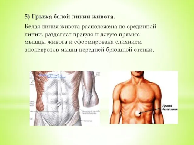 5) Грыжа белой линии живота. Белая линия живота расположена по срединной линии,