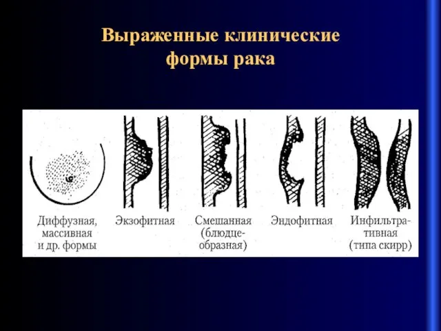 Выраженные клинические формы рака