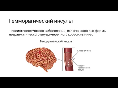 Гемморагический инсульт – полиэтиологическое заболевание, включающее все формы нетравматического внутричерепного кровоизлияния.