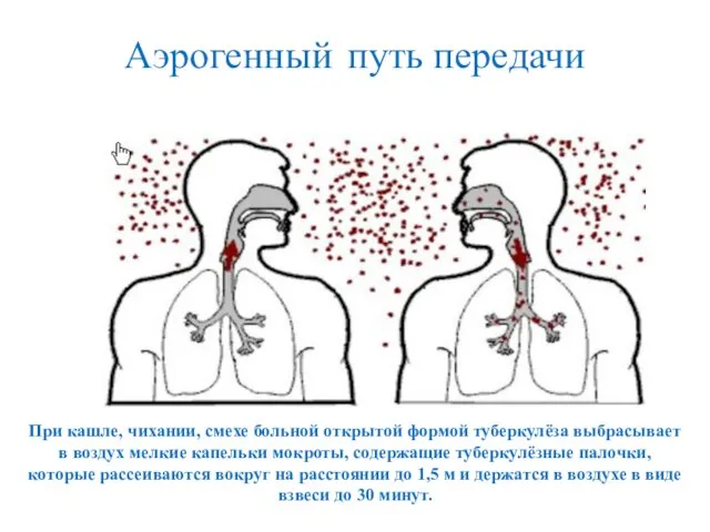 Аэрогенный путь передачи При кашле, чихании, смехе больной открытой формой туберкулёза выбрасывает