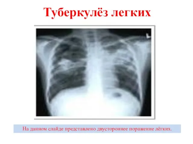 Туберкулёз легких На данном слайде представлено двустороннее поражение лёгких.