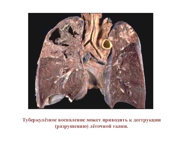Туберкулёзное воспаление может приводить к деструкции (разрушению) лёгочной ткани.