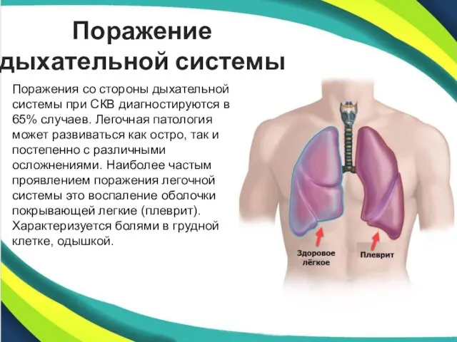 Поражение дыхательной системы Поражения со стороны дыхательной системы при СКВ диагностируются в