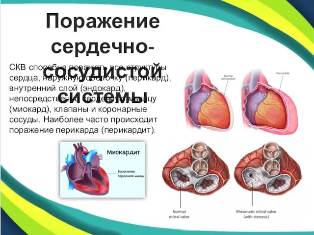 Поражение сердечно-сосудистой системы СКВ способна поражать все структуры сердца, наружную оболочку (перикард),