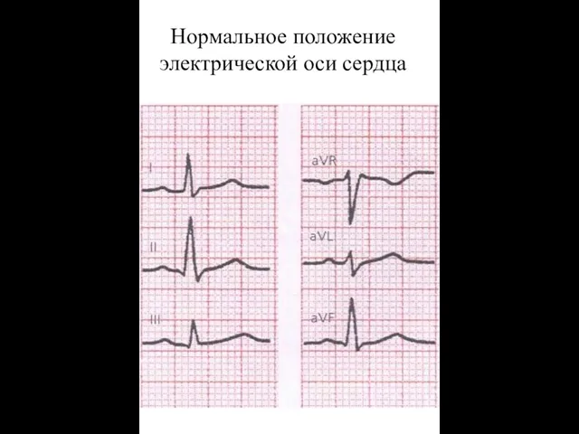 Нормальное положение электрической оси сердца