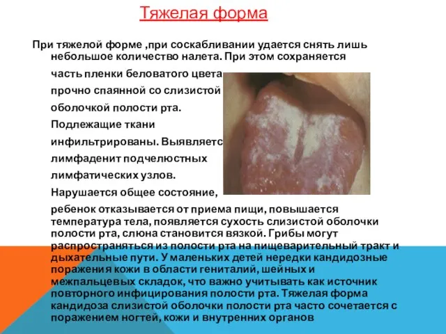 При тяжелой форме ,при соскабливании удается снять лишь небольшое количество налета. При