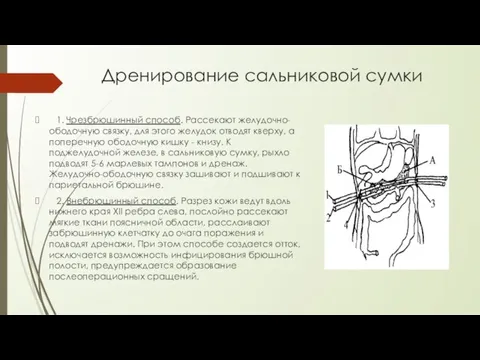 Дренирование сальниковой сумки 1. Чрезбрюшинный способ. Рассекают желудочно-ободочную связку, для этого желудок