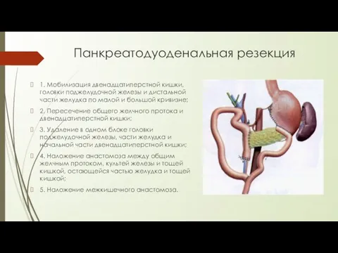 Панкреатодуоденальная резекция 1. Мобилизация двенадцатиперстной кишки, головки поджелудочной железы и дистальной части