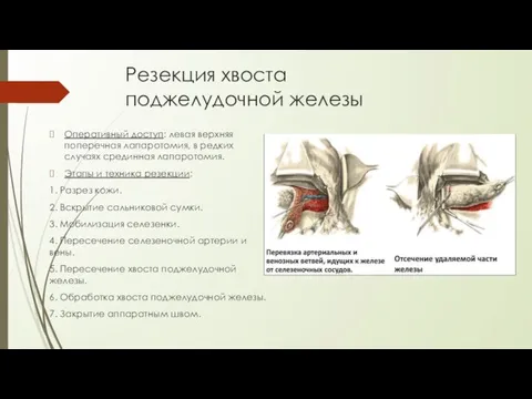 Резекция хвоста поджелудочной железы Оперативный доступ: левая верхняя поперечная лапаротомия, в редких