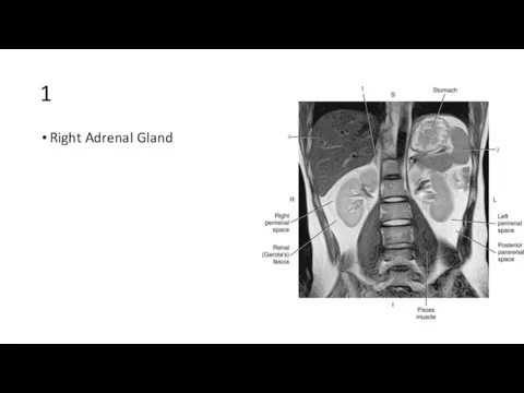 1 Right Adrenal Gland