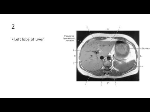 2 Left lobe of Liver