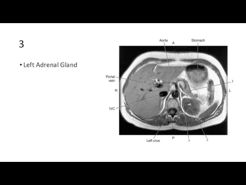 3 Left Adrenal Gland