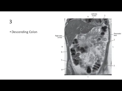 3 Descending Colon