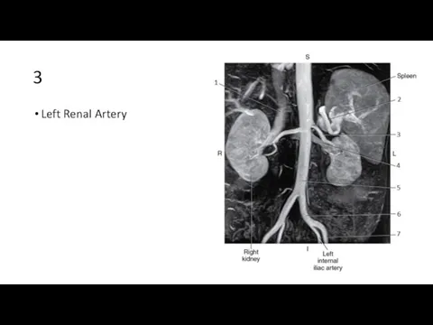 3 Left Renal Artery