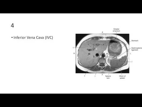 4 Inferior Vena Cava (IVC)