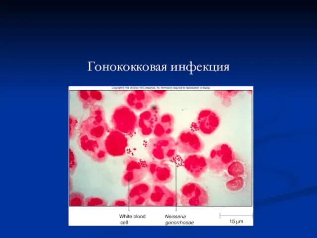 Гонококковая инфекция