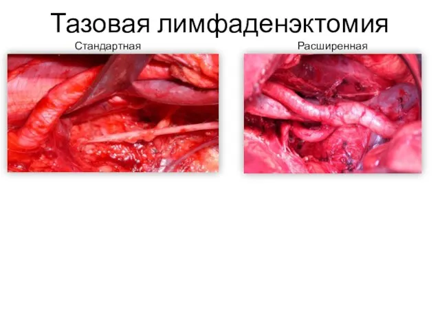 Тазовая лимфаденэктомия Стандартная Расширенная