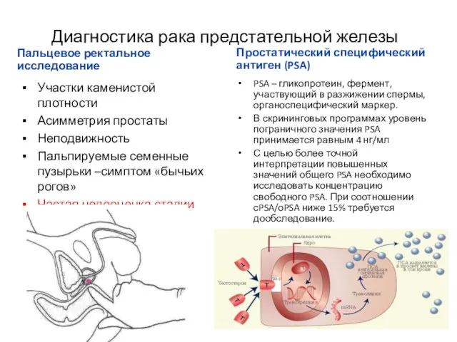 Диагностика рака предстательной железы Пальцевое ректальное исследование Простатический специфический антиген (PSA) Участки