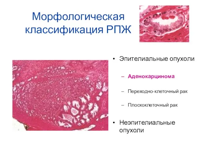 Морфологическая классификация РПЖ Эпителиальные опухоли Аденокарцинома Переходно-клеточный рак Плоскоклеточный рак Неэпителиальные опухоли