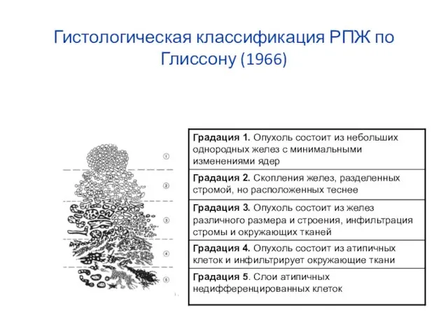 Гистологическая классификация РПЖ по Глиссону (1966)