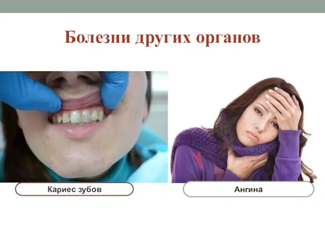 Болезни других органов Ангина Кариес зубов