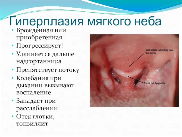 Гиперплазия мягкого неба Врожденная или приобретенная Прогрессирует! Удлиняется дальше надгортанника Препятствует потоку