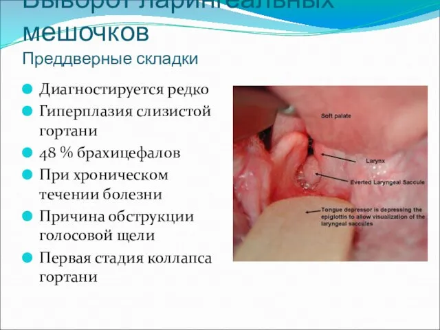 Выворот ларингеальных мешочков Преддверные складки Диагностируется редко Гиперплазия слизистой гортани 48 %