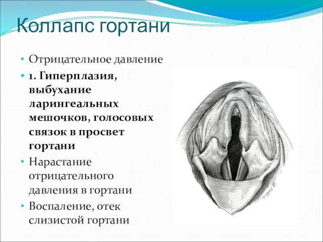 Коллапс гортани Отрицательное давление 1. Гиперплазия, выбухание ларингеальных мешочков, голосовых связок в