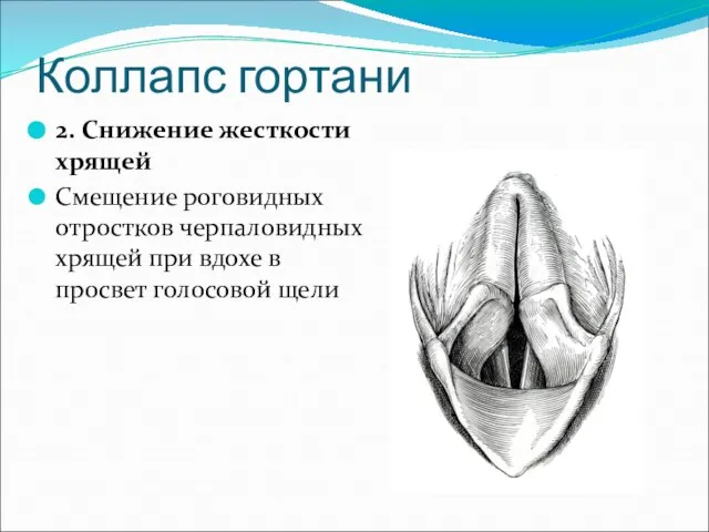 Коллапс гортани 2. Снижение жесткости хрящей Смещение роговидных отростков черпаловидных хрящей при