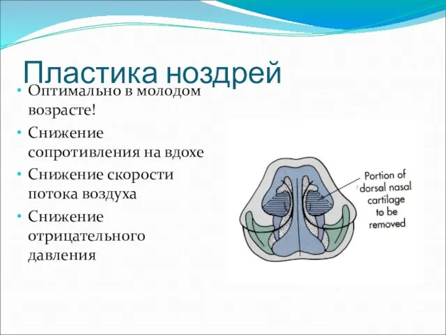 Пластика ноздрей Оптимально в молодом возрасте! Снижение сопротивления на вдохе Снижение скорости