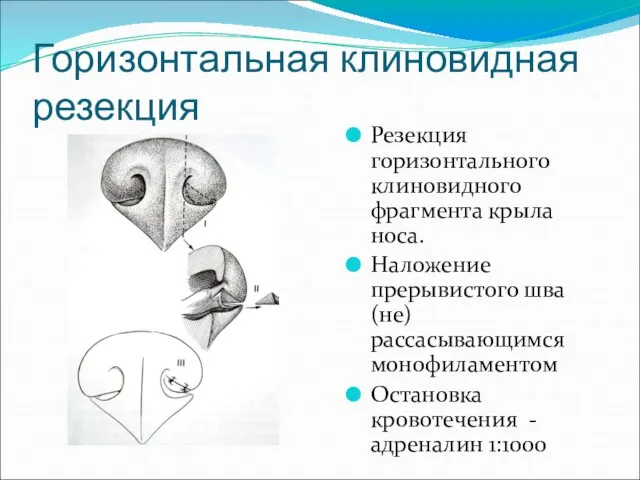 Горизонтальная клиновидная резекция Резекция горизонтального клиновидного фрагмента крыла носа. Наложение прерывистого шва